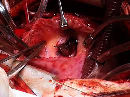 Rescue Cardiac Surgeries