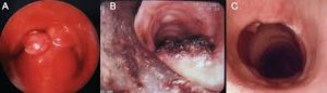 Glomus tumor of the trachea