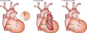 Surgical ventricular restoration with CABG