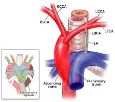 Vascular rings and slings